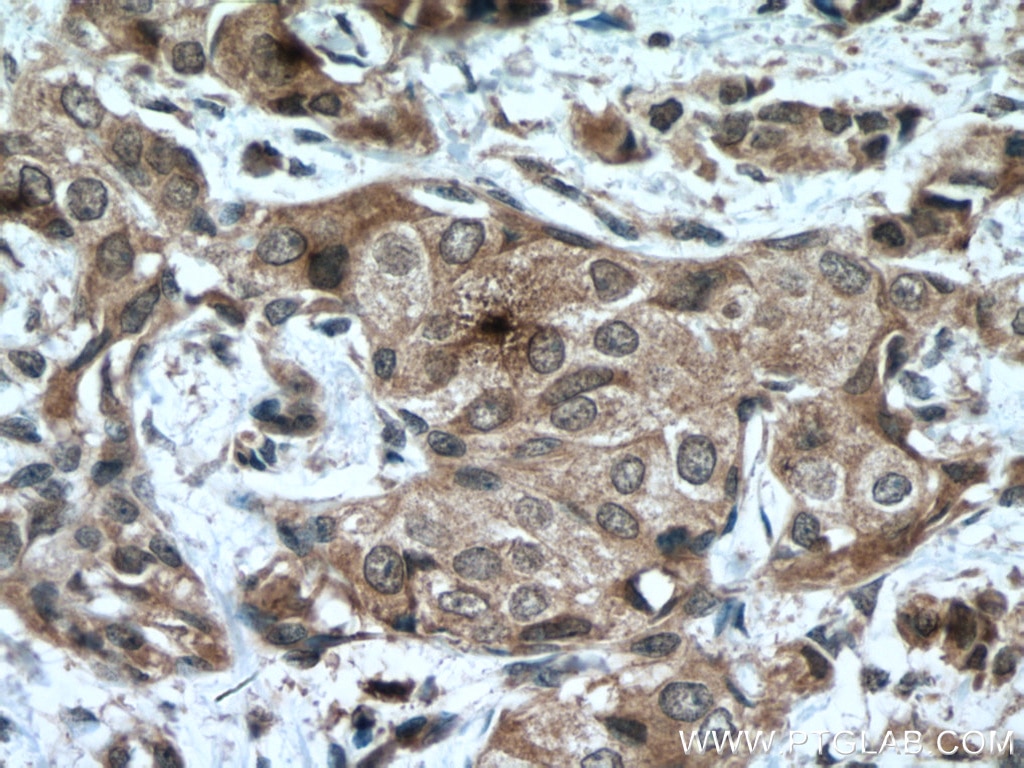Immunohistochemistry (IHC) staining of human breast cancer tissue using SOCS3 Monoclonal antibody (66797-1-Ig)