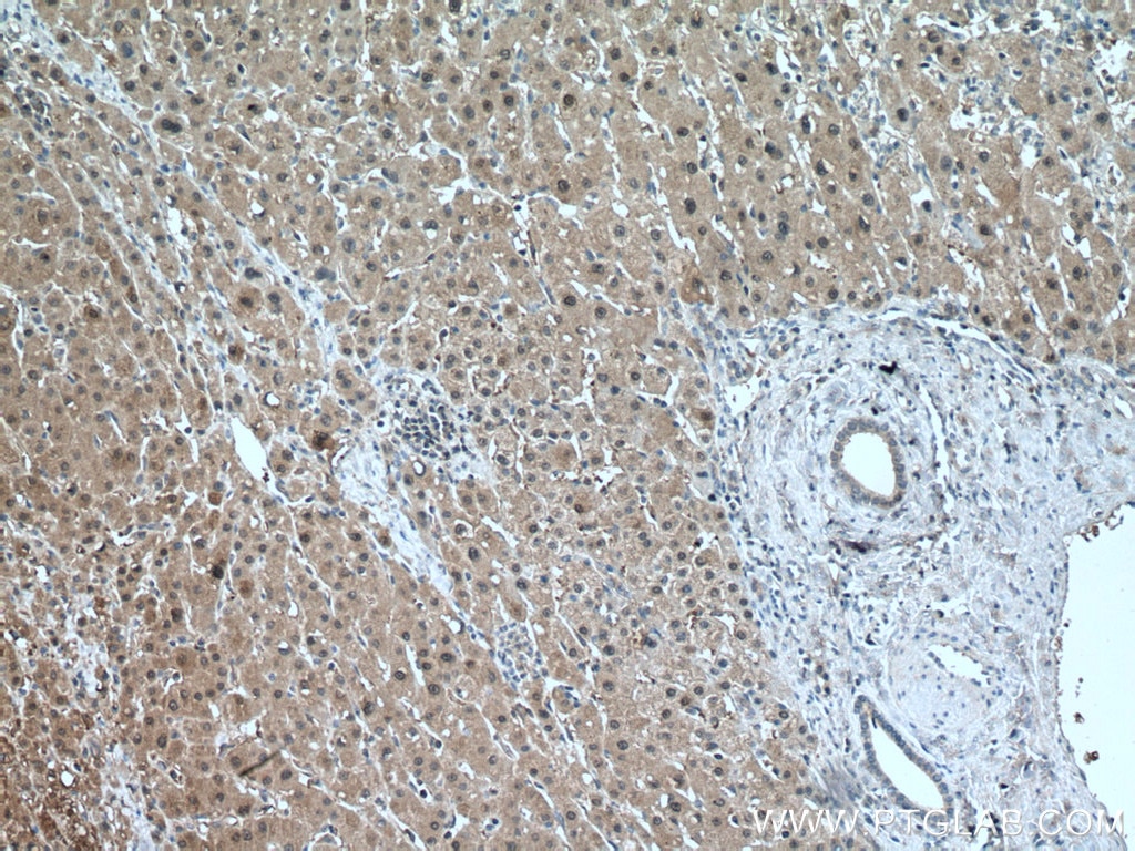 Immunohistochemistry (IHC) staining of human liver cancer tissue using SOD1 Polyclonal antibody (10269-1-AP)