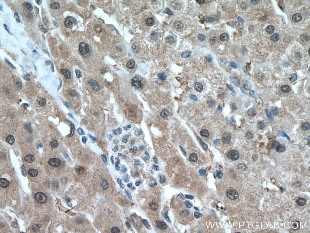 Immunohistochemistry (IHC) staining of human liver cancer tissue using SOD1 Polyclonal antibody (10269-1-AP)