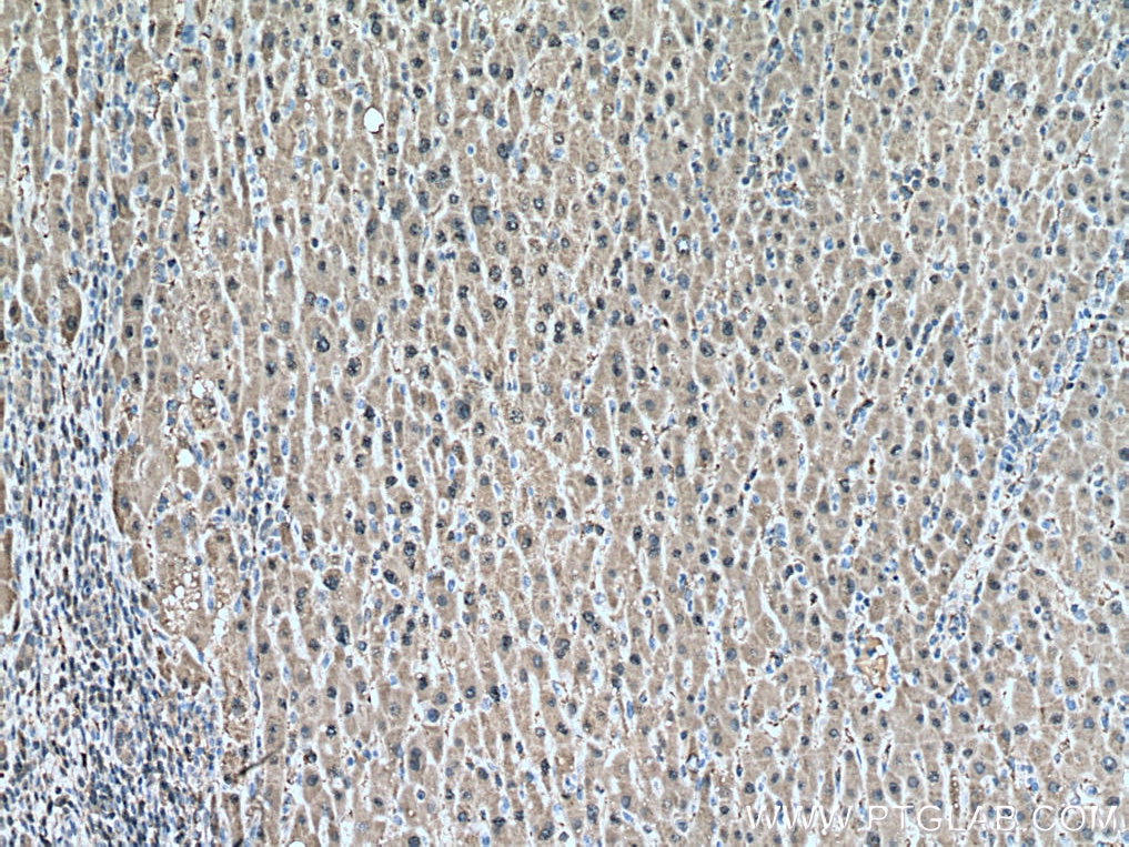 Immunohistochemistry (IHC) staining of human liver cancer tissue using SOD1 Monoclonal antibody (67480-1-Ig)