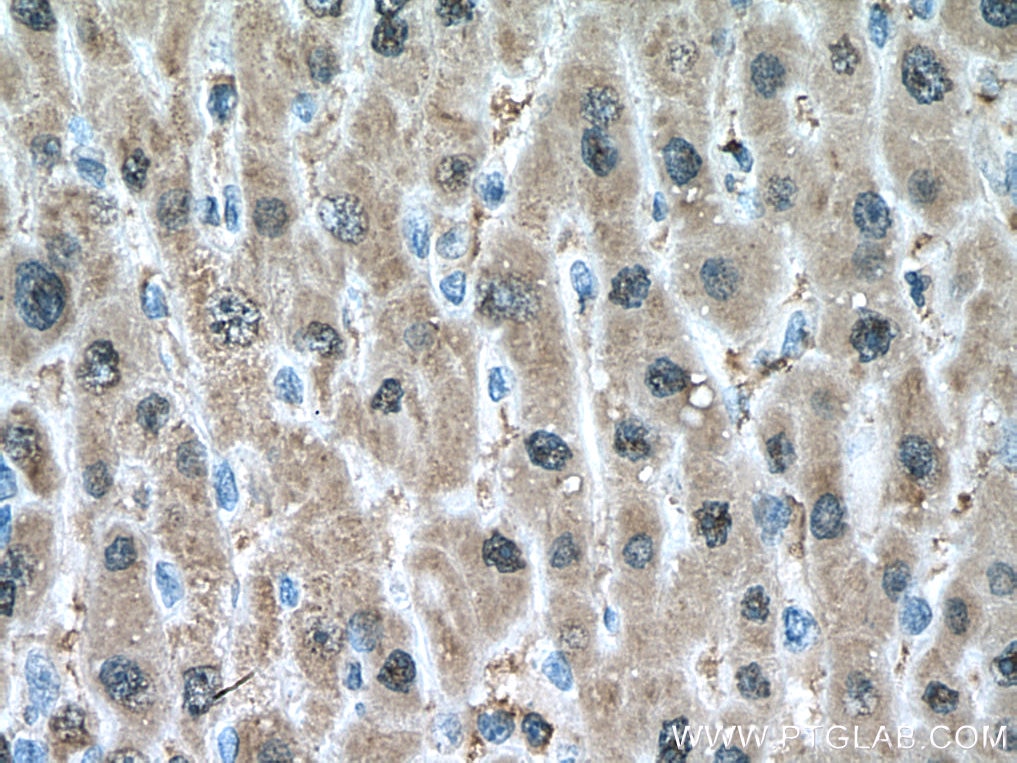 Immunohistochemistry (IHC) staining of human liver cancer tissue using SOD1 Monoclonal antibody (67480-1-Ig)