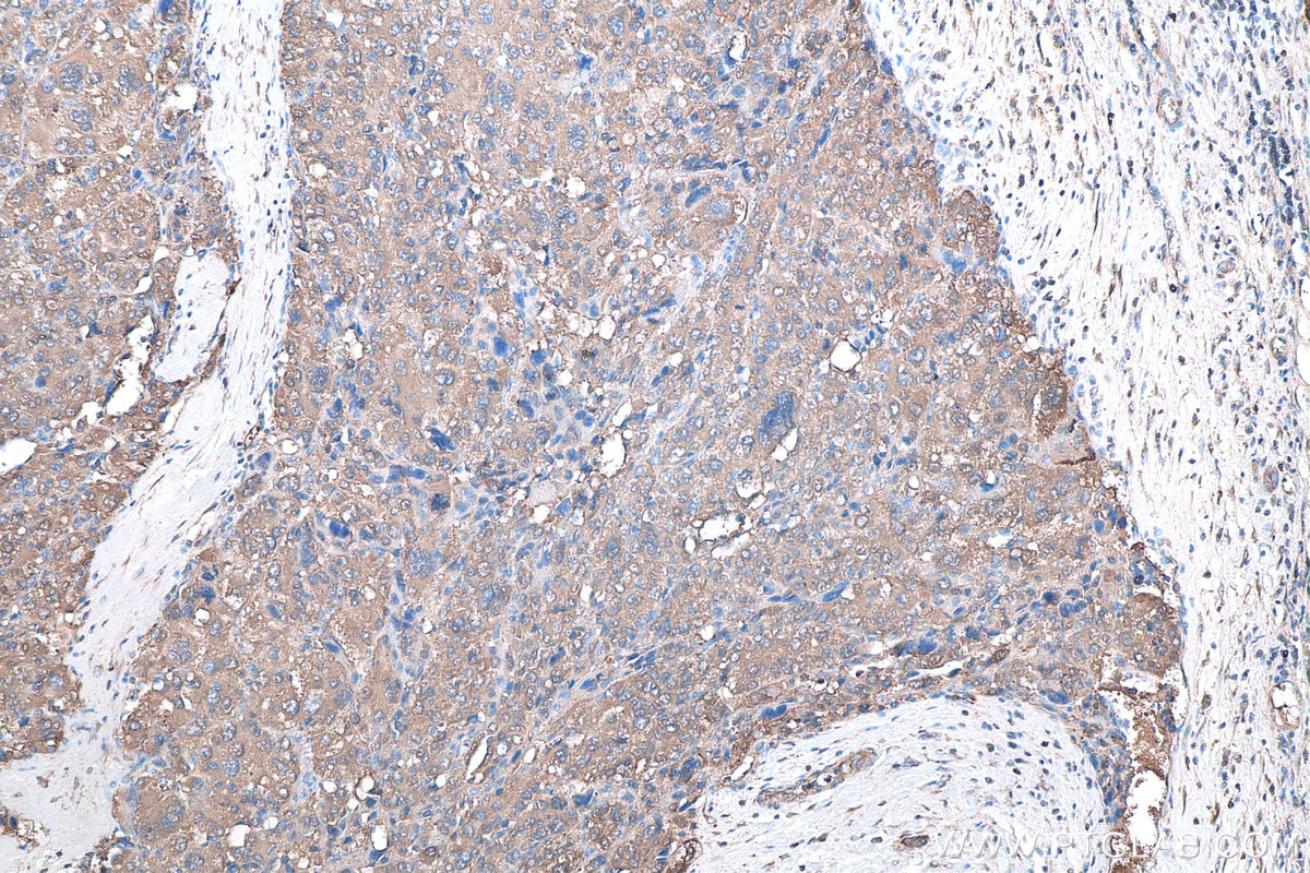 IHC staining of human liver cancer using 67480-1-Ig Immunohistochemistry (IHC) staining of human liver cancer tissue using SOD1 Monoclonal antibody (67480-1-Ig)