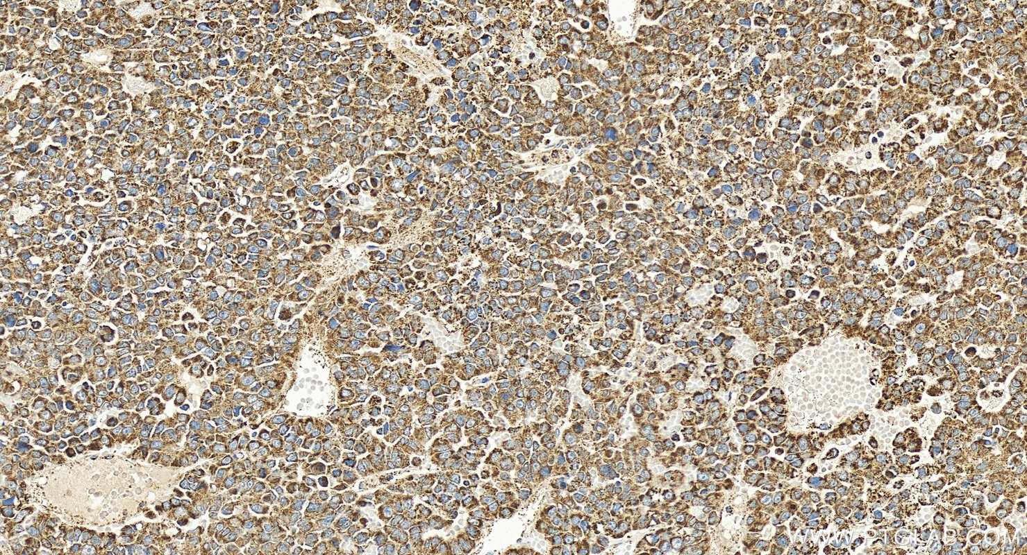Immunohistochemistry (IHC) staining of human hepatocellular carcinoma using SOD2 Polyclonal antibody (24127-1-AP)