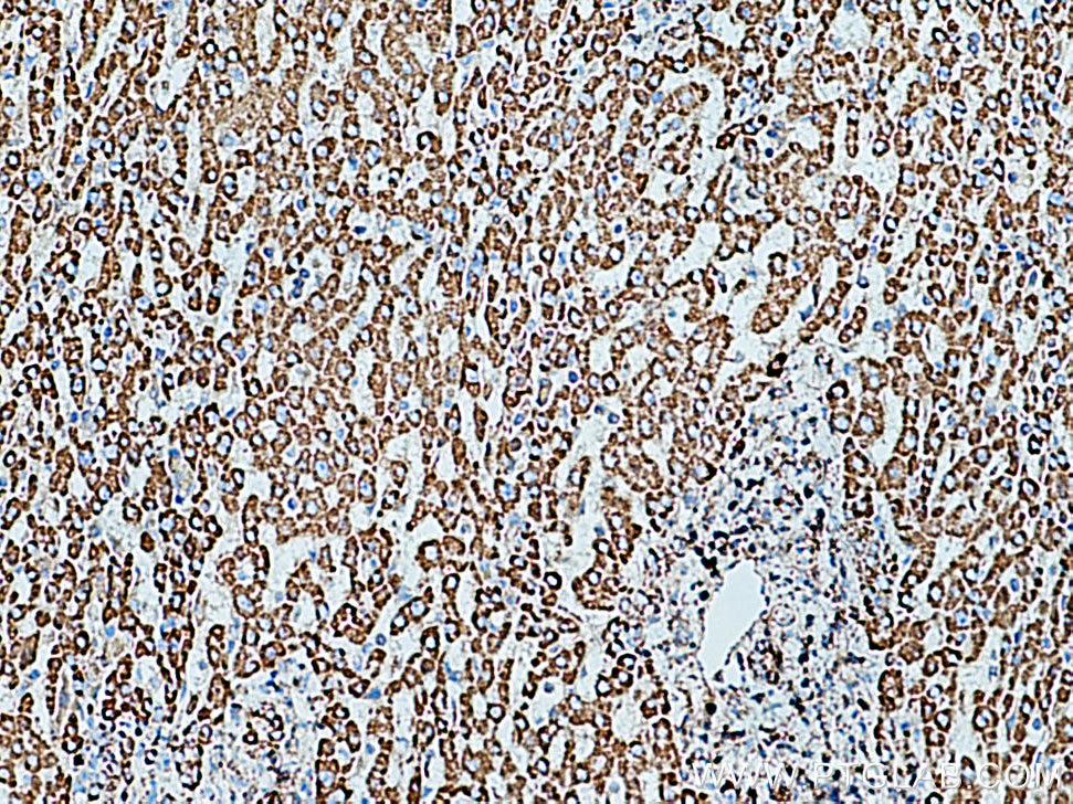 Immunohistochemistry (IHC) staining of human liver cancer tissue using SOD2 Polyclonal antibody (24127-1-AP)