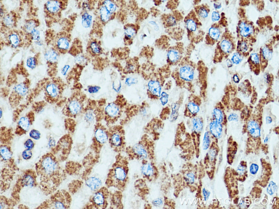 Immunohistochemistry (IHC) staining of human liver cancer tissue using SOD2 Polyclonal antibody (24127-1-AP)
