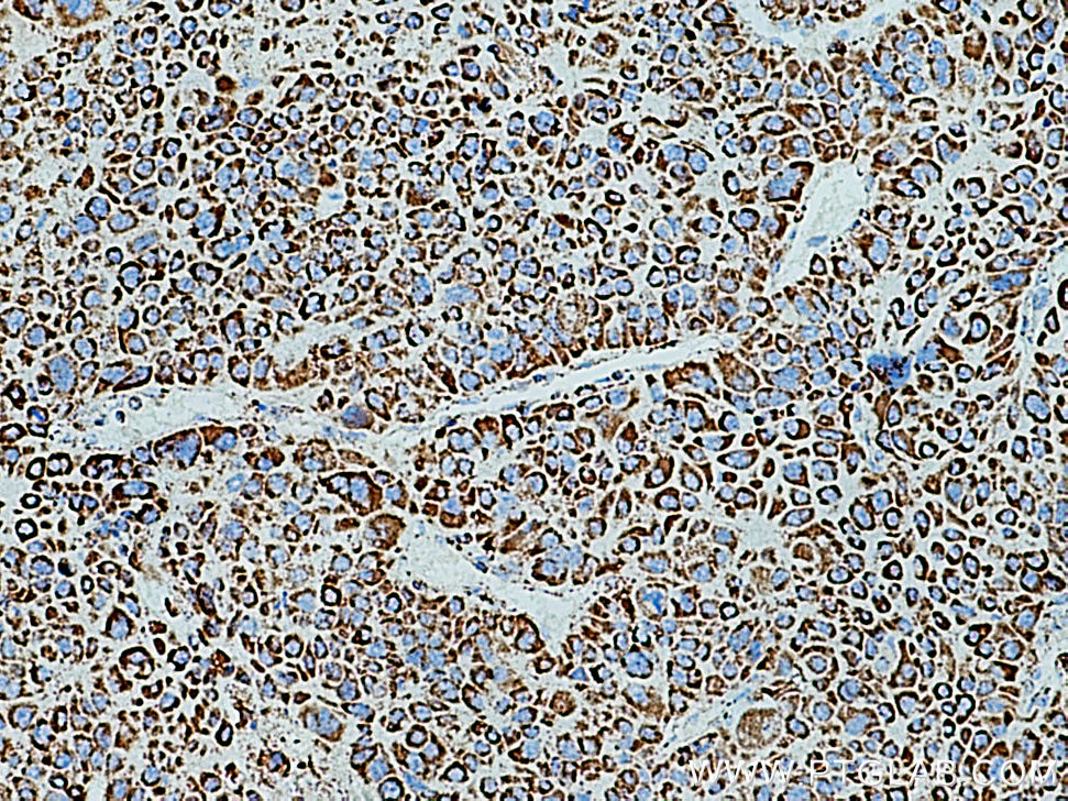 Immunohistochemistry (IHC) staining of human liver cancer tissue using SOD2 Polyclonal antibody (24127-1-AP)