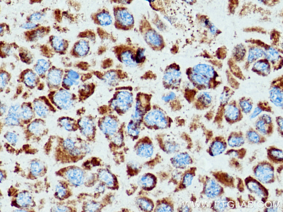 IHC staining of human liver cancer using 24127-1-AP