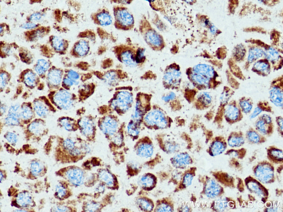 Immunohistochemistry (IHC) staining of human liver cancer tissue using SOD2 Polyclonal antibody (24127-1-AP)