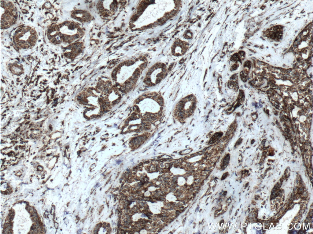 Immunohistochemistry (IHC) staining of human breast cancer tissue using SOD2 Polyclonal antibody (24127-1-AP)