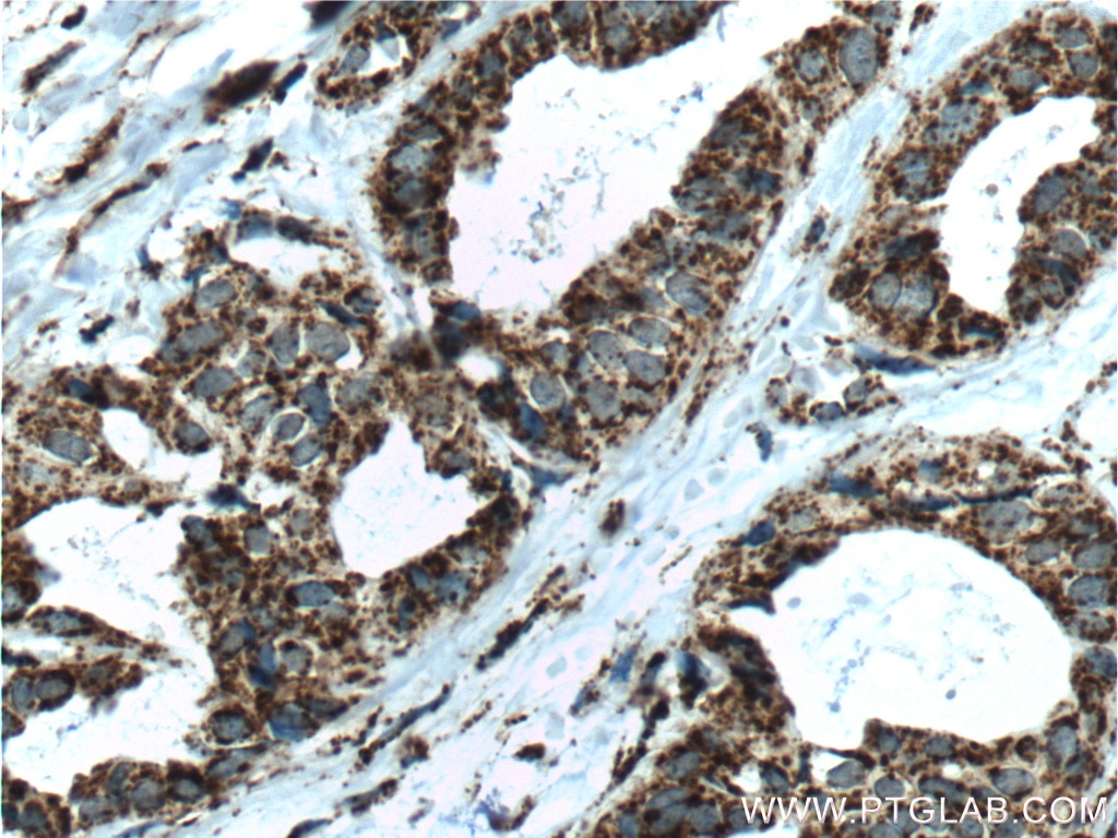 Immunohistochemistry (IHC) staining of human breast cancer tissue using SOD2 Polyclonal antibody (24127-1-AP)