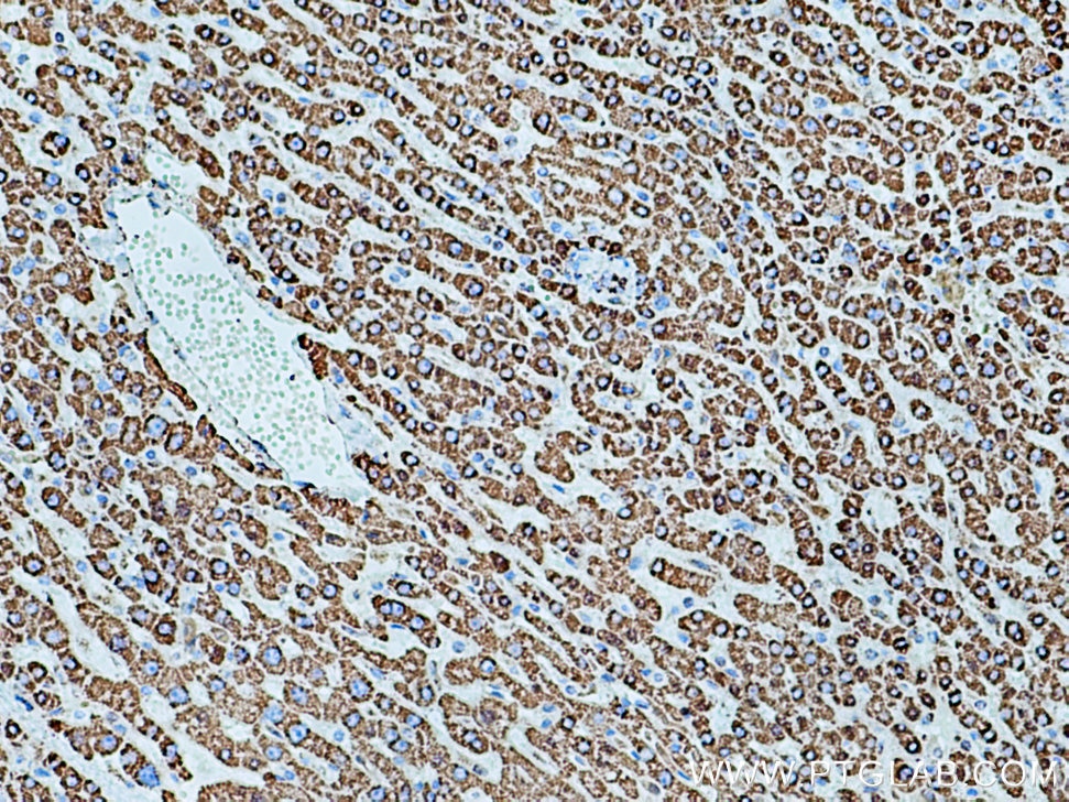 Immunohistochemistry (IHC) staining of human liver cancer tissue using SOD2 Monoclonal antibody (66474-1-Ig)