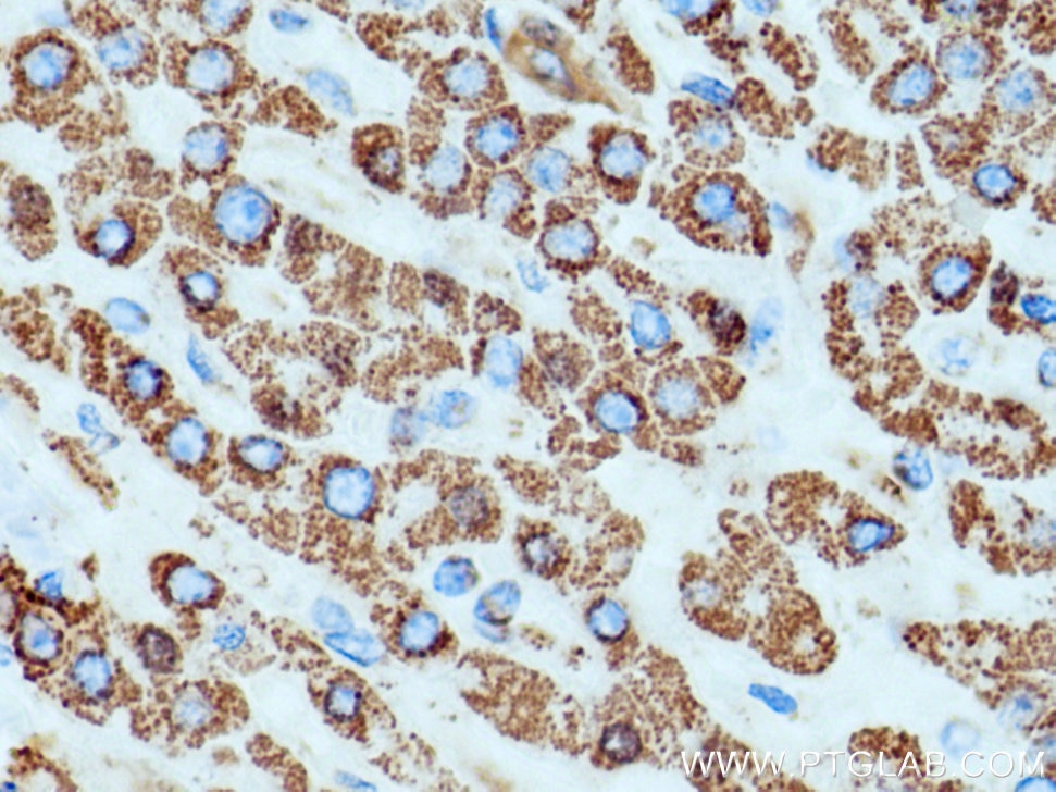 Immunohistochemistry (IHC) staining of human liver cancer tissue using SOD2 Monoclonal antibody (66474-1-Ig)