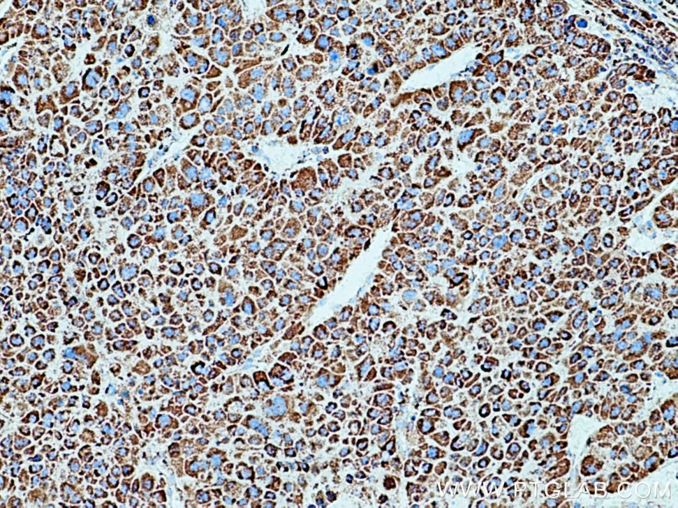 IHC staining of human liver cancer using 66474-1-Ig