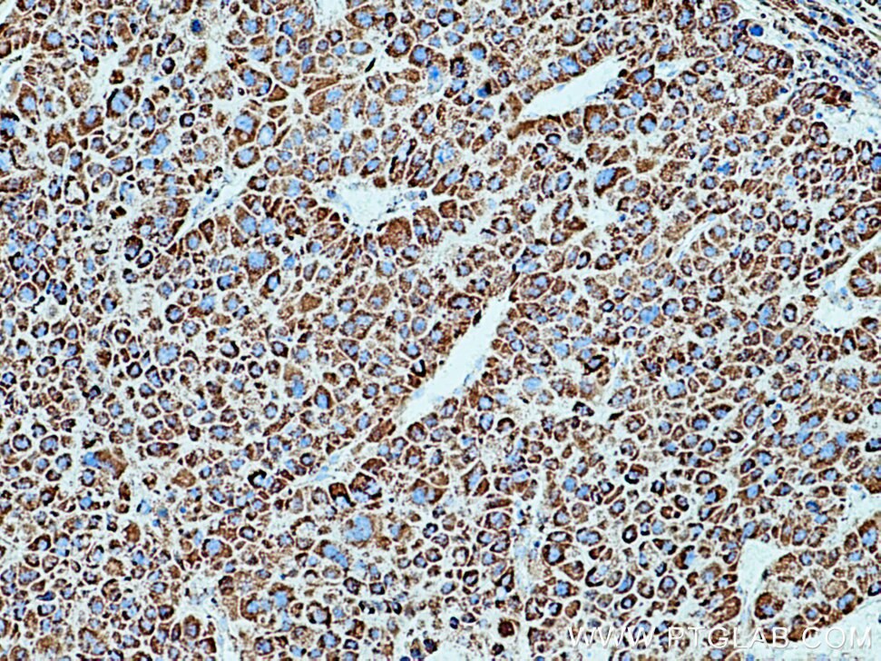 Immunohistochemistry (IHC) staining of human liver cancer tissue using SOD2 Monoclonal antibody (66474-1-Ig)