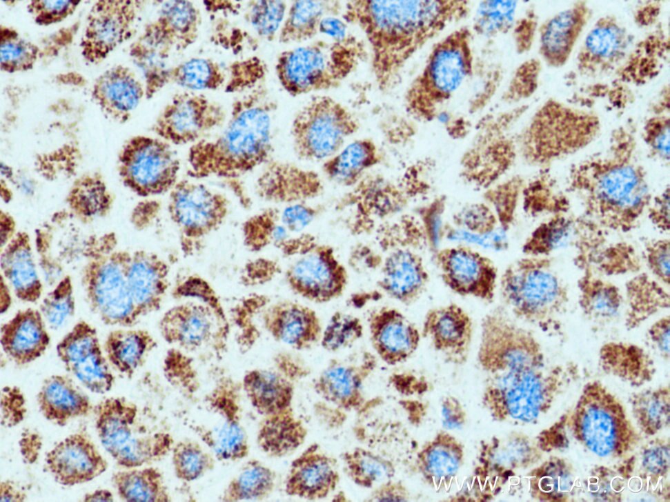 Immunohistochemistry (IHC) staining of human liver cancer tissue using SOD2 Monoclonal antibody (66474-1-Ig)