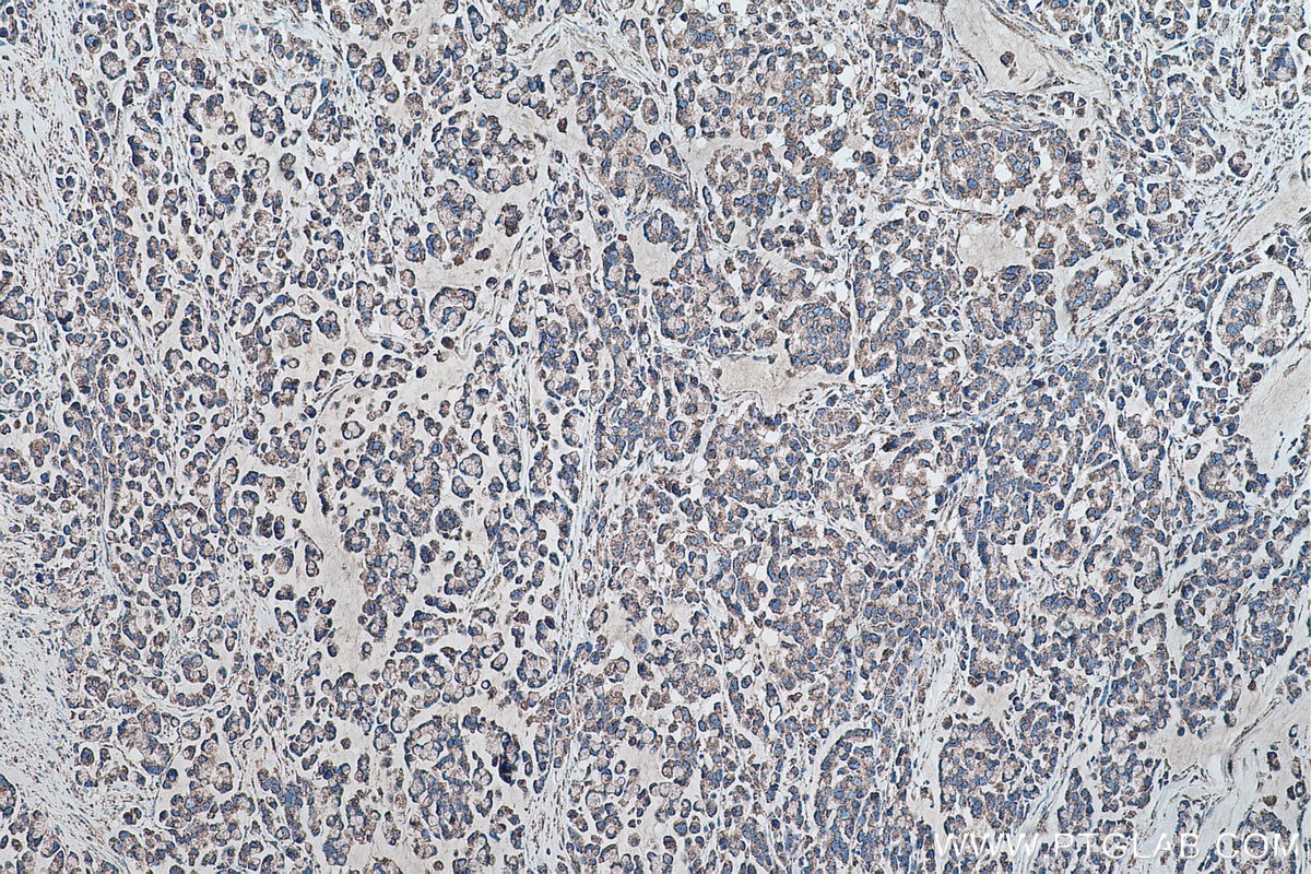 IHC staining of human colon cancer using 66474-1-Ig