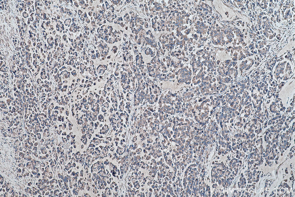 Immunohistochemistry (IHC) staining of human colon cancer tissue using SOD2 Monoclonal antibody (66474-1-Ig)