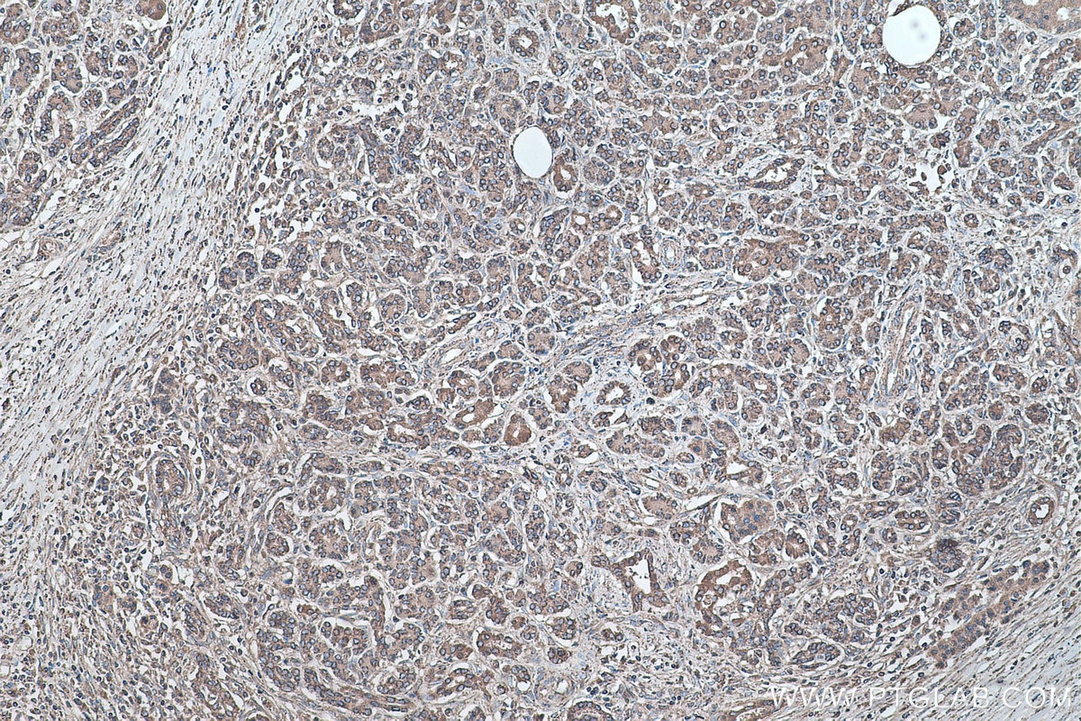 Immunohistochemistry (IHC) staining of human pancreas cancer tissue using SOD2 Monoclonal antibody (66474-1-Ig)