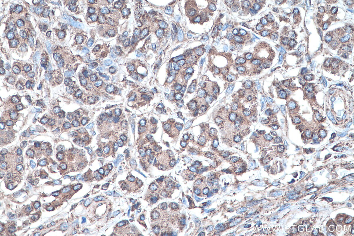 Immunohistochemistry (IHC) staining of human pancreas cancer tissue using SOD2 Monoclonal antibody (66474-1-Ig)