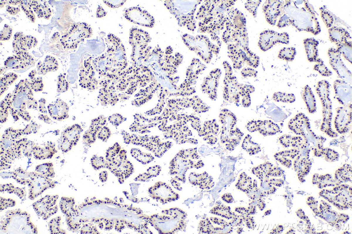 Immunohistochemistry (IHC) staining of human thyroid cancer tissue using SON Polyclonal antibody (28046-1-AP)