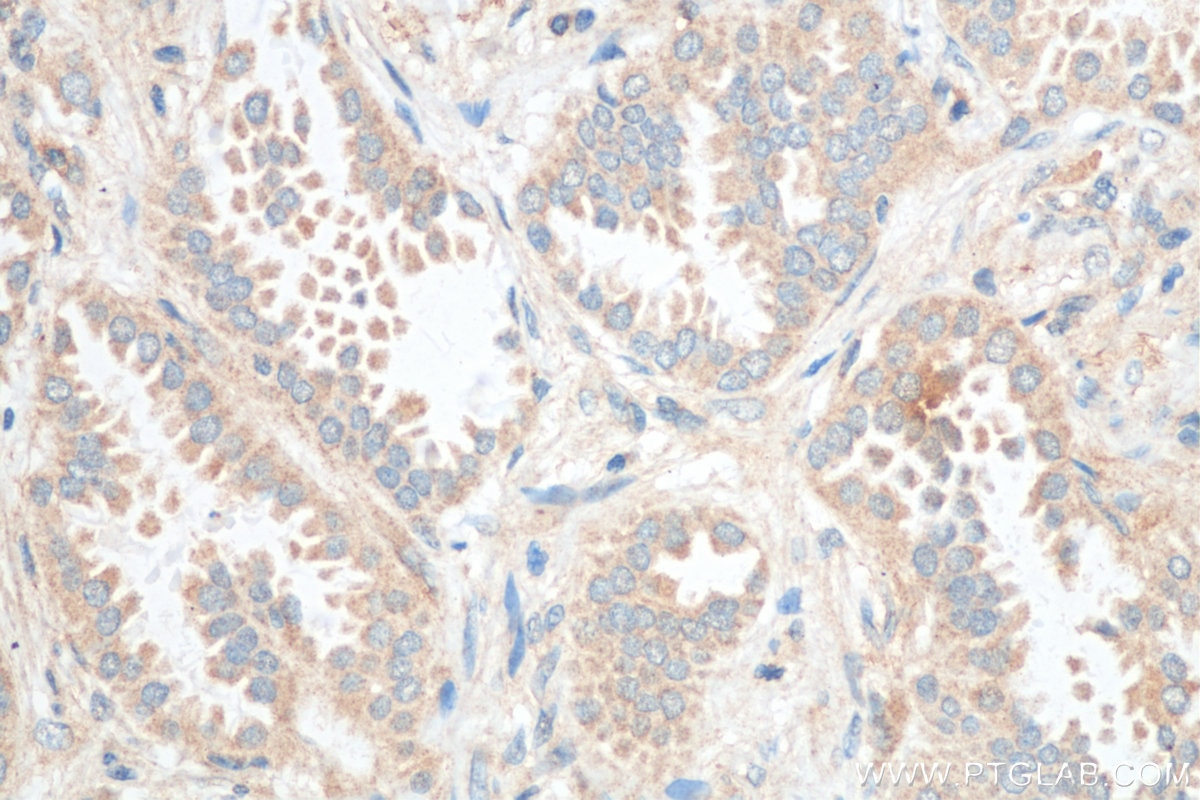 Immunohistochemistry (IHC) staining of human lung cancer tissue using SOS1 Polyclonal antibody (55041-1-AP)