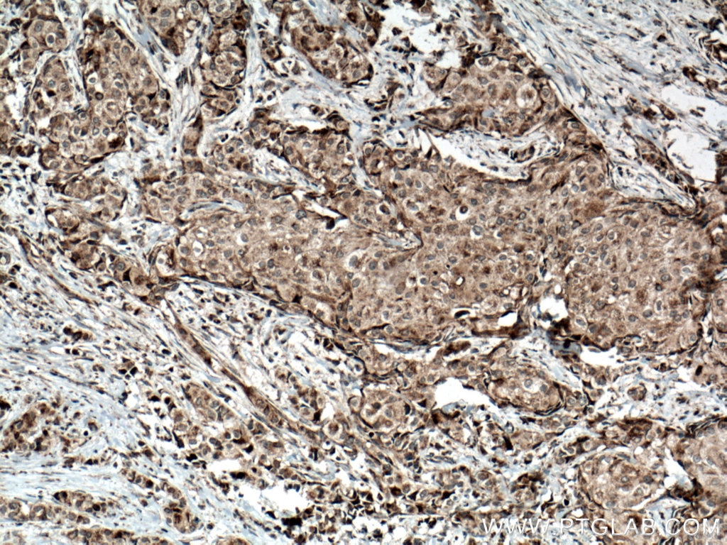 Immunohistochemistry (IHC) staining of human breast cancer tissue using Sclerostin Polyclonal antibody (21933-1-AP)
