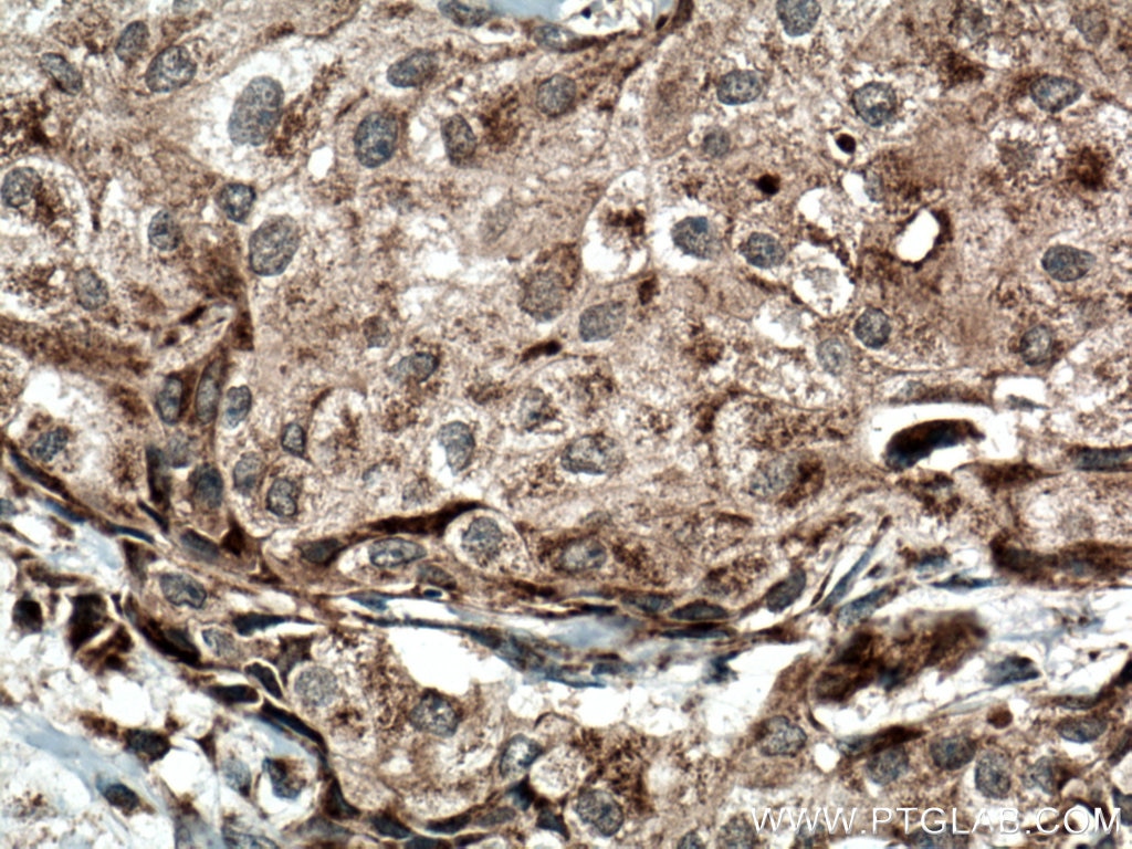 Immunohistochemistry (IHC) staining of human breast cancer tissue using Sclerostin Polyclonal antibody (21933-1-AP)