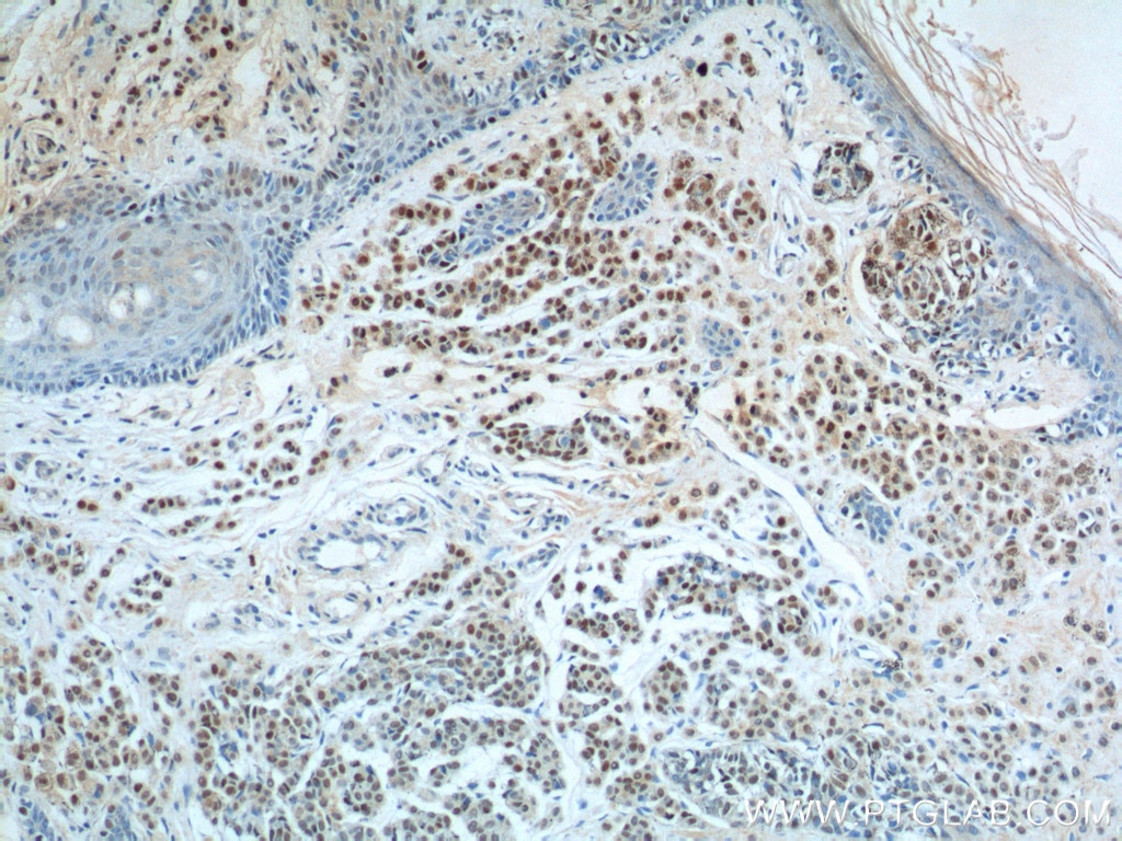 IHC staining of human malignant melanoma using 66786-1-Ig