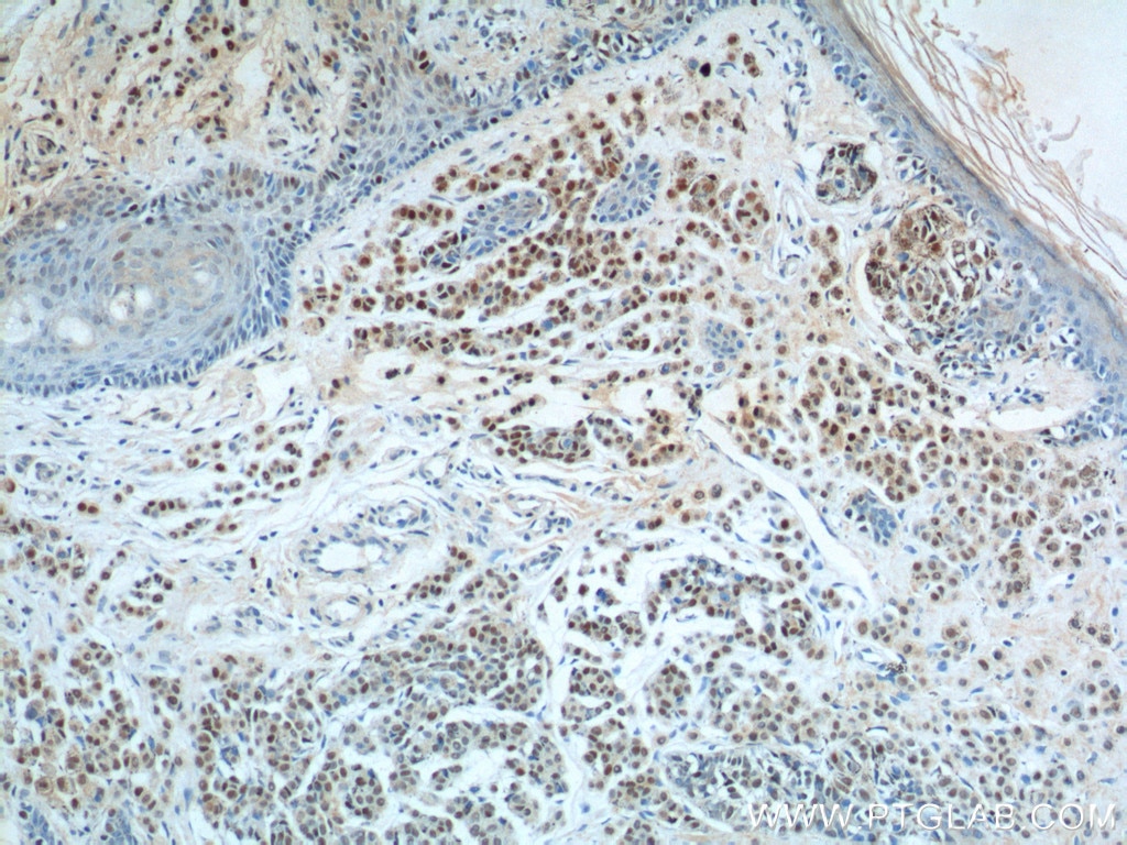 Immunohistochemistry (IHC) staining of human malignant melanoma tissue using SOX10 Monoclonal antibody (66786-1-Ig)