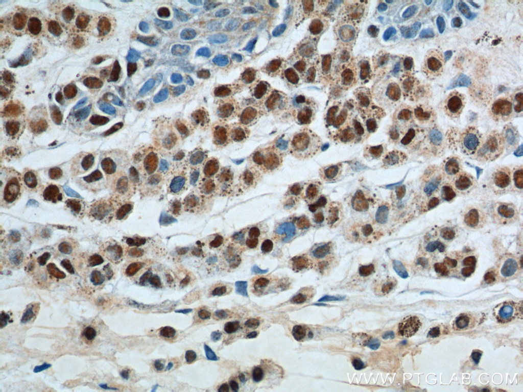 Immunohistochemistry (IHC) staining of human malignant melanoma tissue using SOX10 Monoclonal antibody (66786-1-Ig)