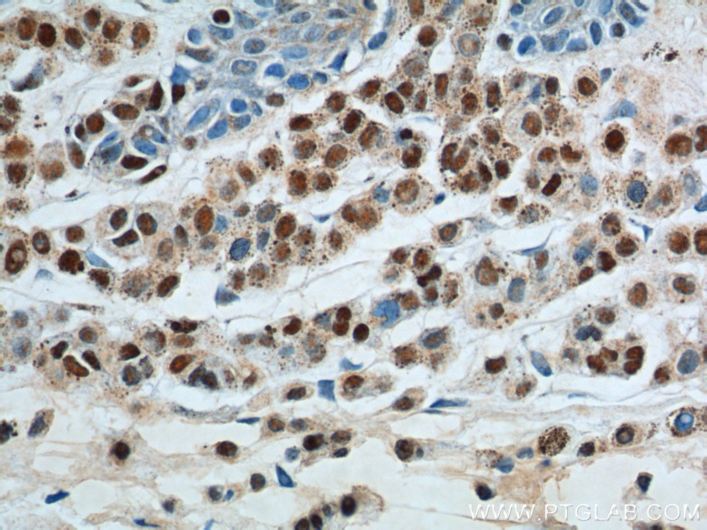 IHC staining of human malignant melanoma using 66786-1-Ig