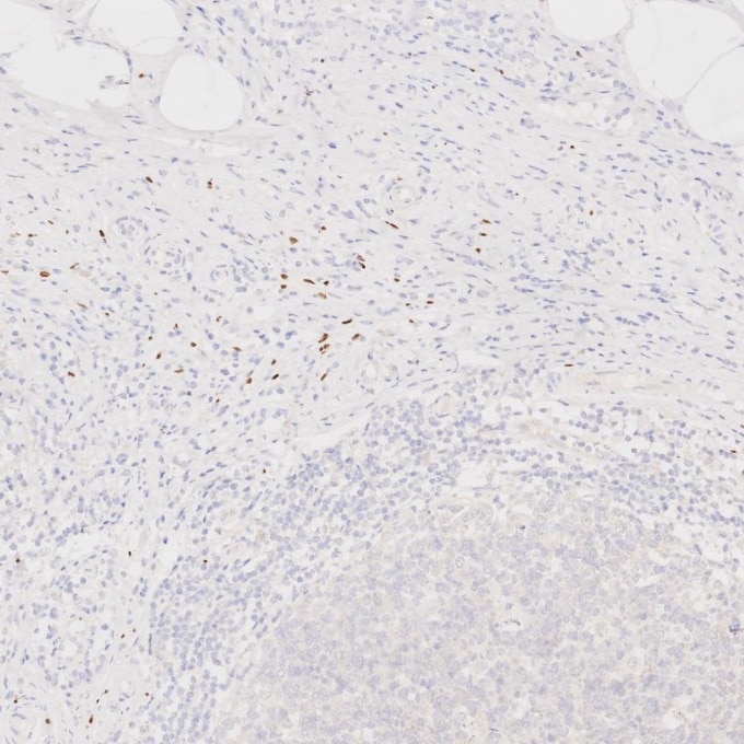 Immunohistochemistry (IHC) staining of human appendicitis tissue using SOX10 Monoclonal antibody (66786-1-Ig)