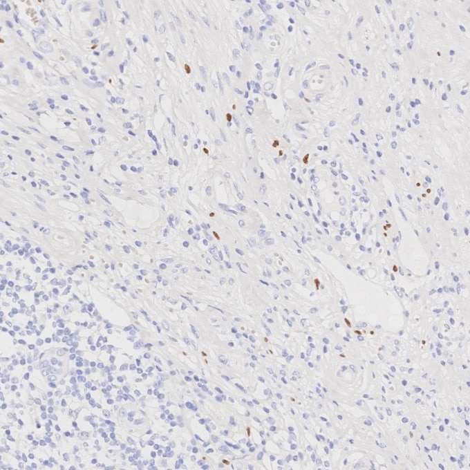 Immunohistochemistry (IHC) staining of human appendicitis tissue using SOX10 Monoclonal antibody (66786-1-Ig)