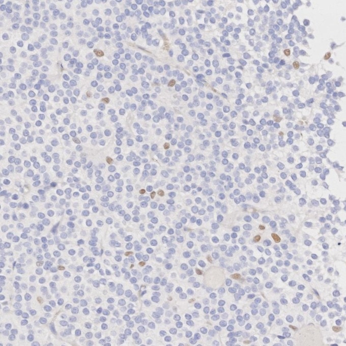 Immunohistochemistry (IHC) staining of human pituitary adenoma tissue using SOX10 Monoclonal antibody (66786-1-Ig)