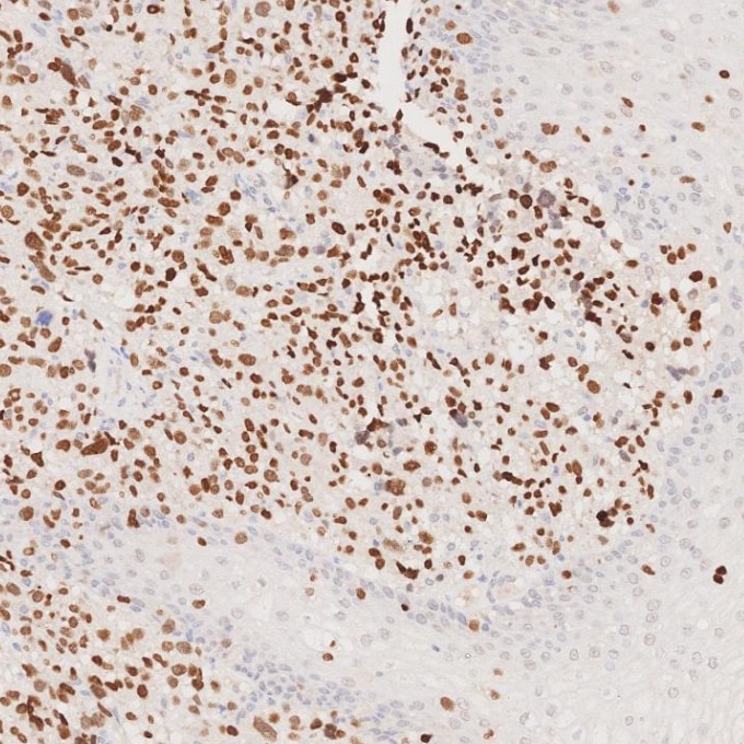 Immunohistochemistry (IHC) staining of human malignant melanoma tissue using SOX10 Monoclonal antibody (66786-1-Ig)