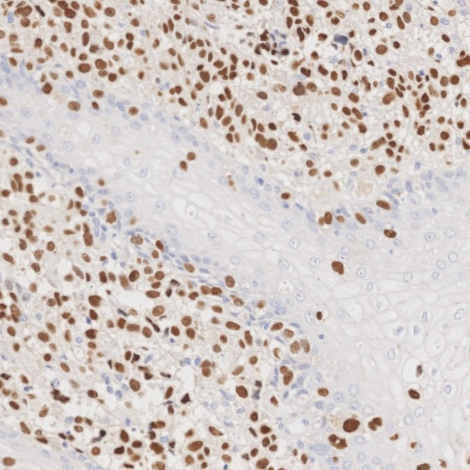 Immunohistochemistry (IHC) staining of human malignant melanoma tissue using SOX10 Monoclonal antibody (66786-1-Ig)
