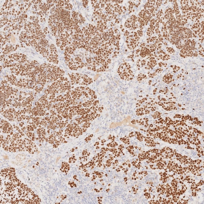 Immunohistochemistry (IHC) staining of human malignant melanoma tissue using SOX10 Monoclonal antibody (66786-1-Ig)