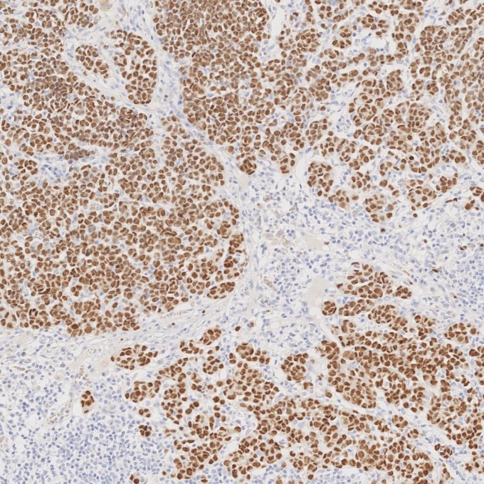 Immunohistochemistry (IHC) staining of human malignant melanoma tissue using SOX10 Monoclonal antibody (66786-1-Ig)