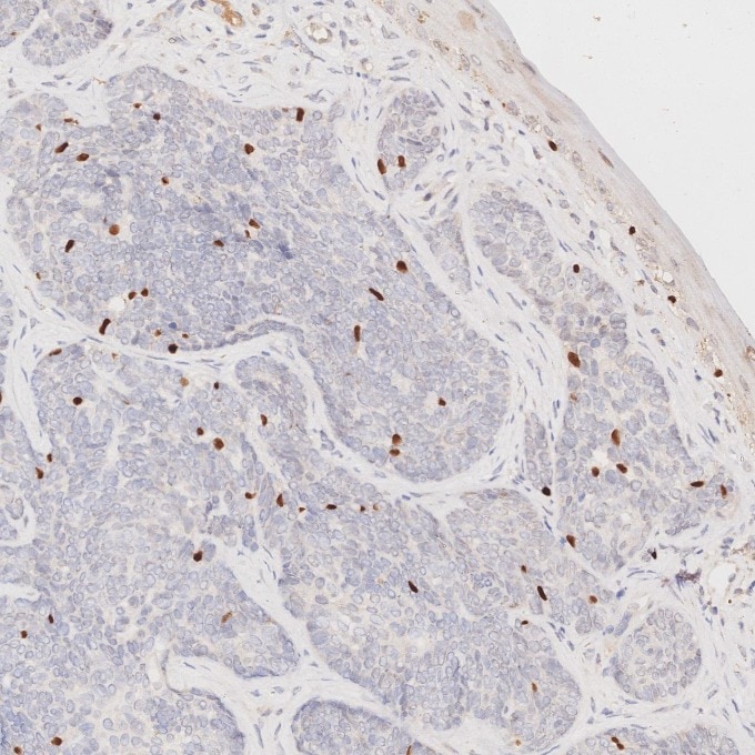 Immunohistochemistry (IHC) staining of human skin cancer tissue using SOX10 Monoclonal antibody (66786-1-Ig)