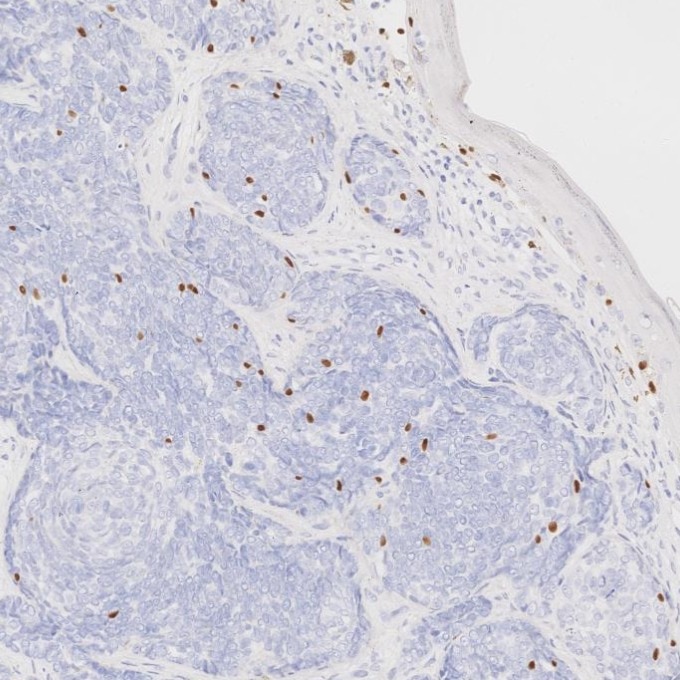 Immunohistochemistry (IHC) staining of human skin cancer tissue using SOX10 Monoclonal antibody (66786-1-Ig)