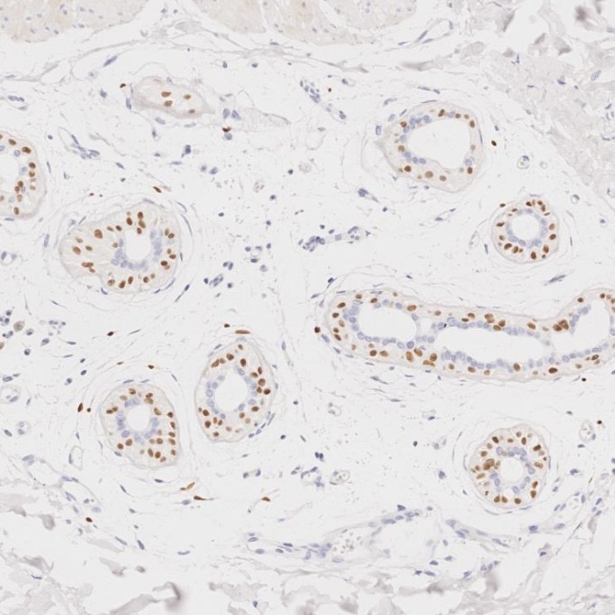 Immunohistochemistry (IHC) staining of human skin cancer tissue using SOX10 Monoclonal antibody (66786-1-Ig)