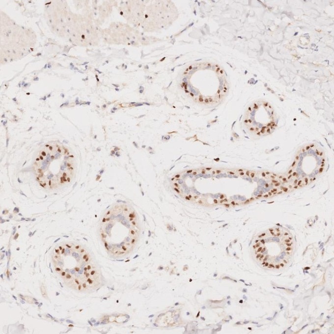 Immunohistochemistry (IHC) staining of human skin cancer tissue using SOX10 Monoclonal antibody (66786-1-Ig)