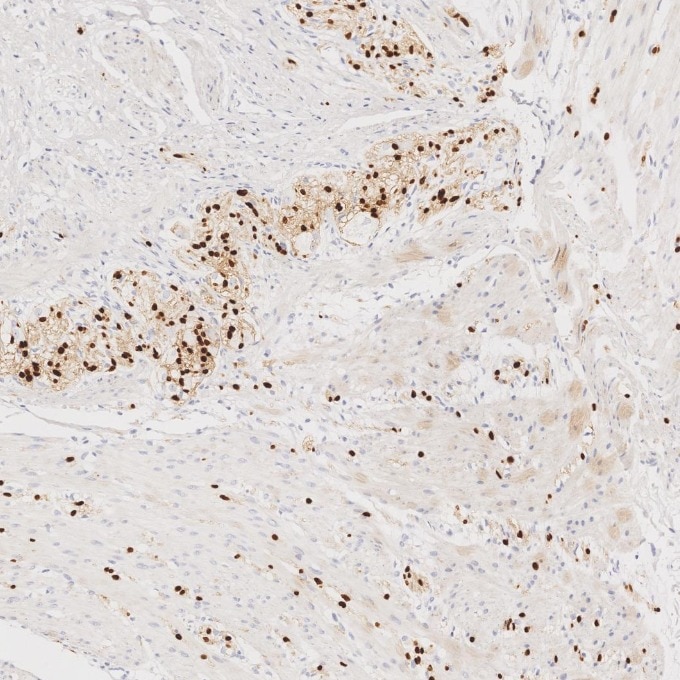 IHC staining of human colorectal cancer using 87051-3-RR (same clone as 87051-3-PBS) Immunohistochemistry (IHC) staining of human colorectal cancer tissue using SOX10 Recombinant monoclonal antibody (87051-3-RR)