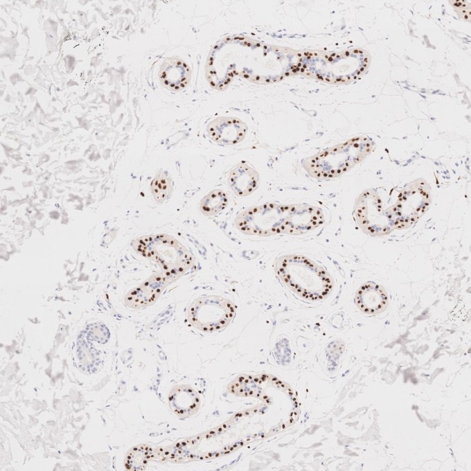 IHC staining of human skin cancer using 87051-3-RR (same clone as 87051-3-PBS) Immunohistochemistry (IHC) staining of human skin cancer tissue using SOX10 Recombinant monoclonal antibody (87051-3-RR)