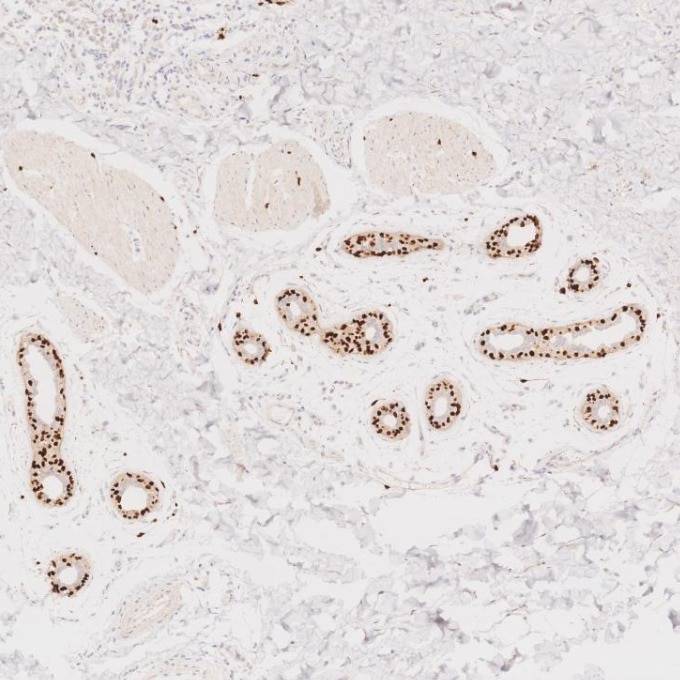 IHC staining of human skin cancer using 87051-3-RR (same clone as 87051-3-PBS) Immunohistochemistry (IHC) staining of human skin cancer tissue using SOX10 Recombinant monoclonal antibody (87051-3-RR)