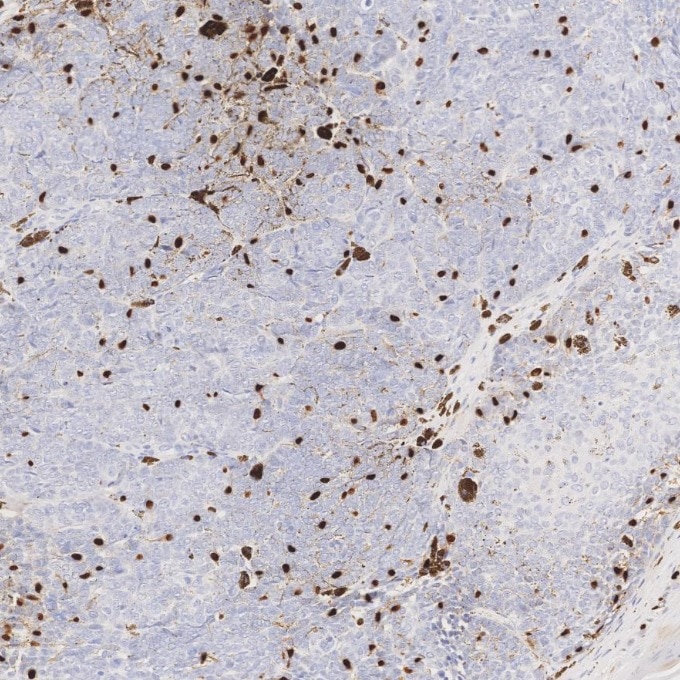 IHC staining of human skin cancer using 87051-3-RR (same clone as 87051-3-PBS) Immunohistochemistry (IHC) staining of human skin cancer tissue using SOX10 Recombinant monoclonal antibody (87051-3-RR)