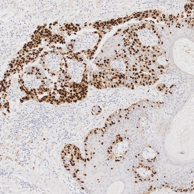 IHC staining of human malignant melanoma using 87051-3-RR (same clone as 87051-3-PBS) Immunohistochemistry (IHC) staining of human malignant melanoma tissue using SOX10 Recombinant monoclonal antibody (87051-3-RR)