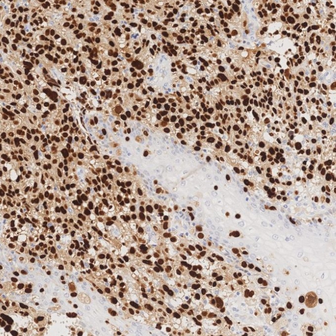 IHC staining of human malignant melanoma using 87051-3-RR (same clone as 87051-3-PBS) Immunohistochemistry (IHC) staining of human malignant melanoma tissue using SOX10 Recombinant monoclonal antibody (87051-3-RR)