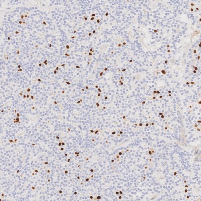 IHC staining of human pituitary adenoma using 87051-3-RR (same clone as 87051-3-PBS) Immunohistochemistry (IHC) staining of human pituitary adenoma tissue using SOX10 Recombinant monoclonal antibody (87051-3-RR)