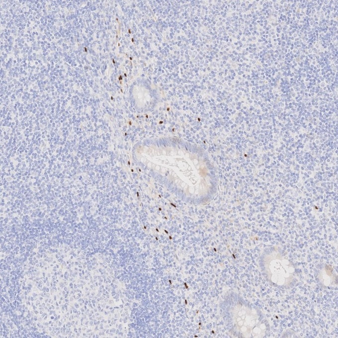 IHC staining of human appendicitis using 87051-3-RR (same clone as 87051-3-PBS) Immunohistochemistry (IHC) staining of human appendicitis tissue using SOX10 Recombinant monoclonal antibody (87051-3-RR)